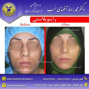 دکتر محمدرضا آخوندی نسب - راینوپلاستی