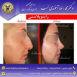 دکتر محمدرضا آخوندی نسب - راینوپلاستی
