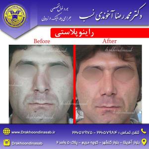 دکتر محمدرضا آخوندی نسب - راینوپلاستی