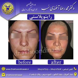 دکتر محمدرضا آخوندی نسب - راینوپلاستی