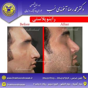 دکتر محمدرضا آخوندی نسب - راینوپلاستی