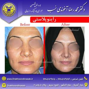 دکتر محمدرضا آخوندی نسب - راینوپلاستی