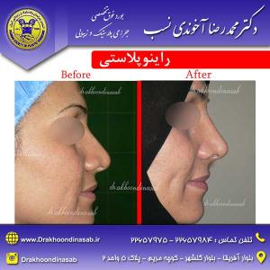 دکتر محمدرضا آخوندی نسب - راینوپلاستی