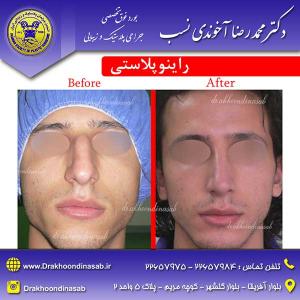 دکتر محمدرضا آخوندی نسب - راینوپلاستی