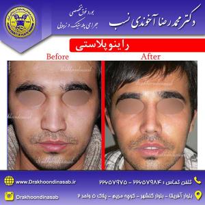 دکتر محمدرضا آخوندی نسب - راینوپلاستی