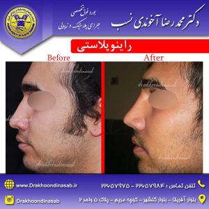 دکتر محمدرضا آخوندی نسب - راینوپلاستی