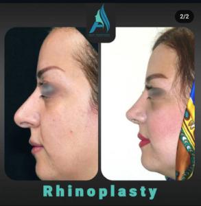 جراحی-بینی-طبیعی-78-1