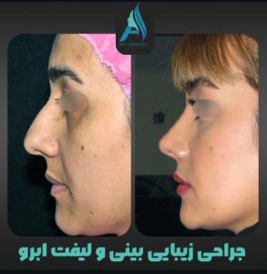 جراحی-بینی-طبیعی-79