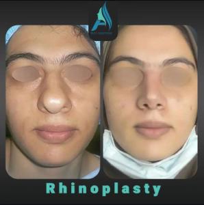 جراحی-بینی-طبیعی-81