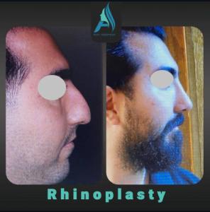 جراحی-بینی-طبیعی-82