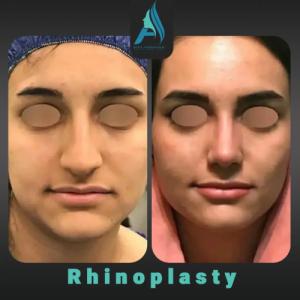 جراحی-بینی-طبیعی-84