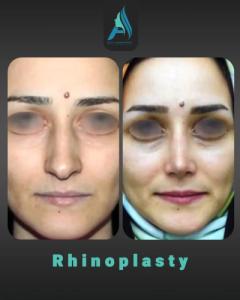 جراحی-بینی-طبییعی