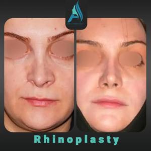 جراحی-ترمیمی-بینی-85
