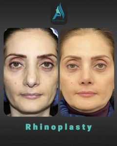 جراحی-طبییعی-بینی-100