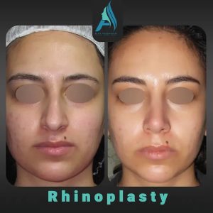 جراحی-طبییعی-بینی-101