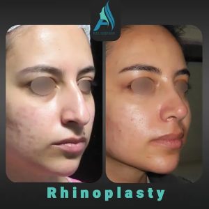 جراحی-طبییعی-بینی-102
