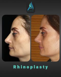 جراحی-طبییعی-بینی-103