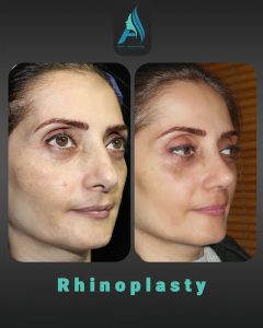 جراحی-طبییعی-بینی-104