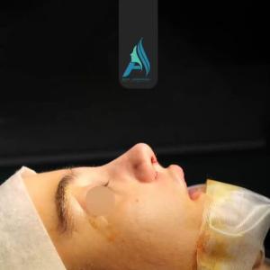 جراحی-طبییعی-بینی-105