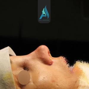 جراحی-طبییعی-بینی-107