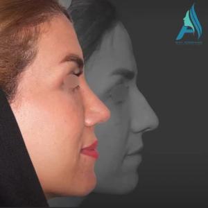 جراحی-طبییعی-بینی-108