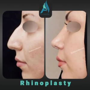 جراحی-طبییعی-بینی-86