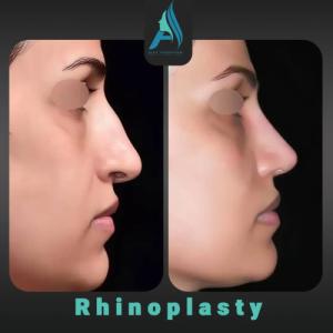 جراحی-طبییعی-بینی-88