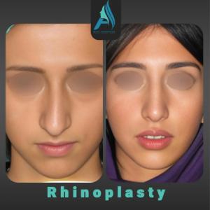 جراحی-طبییعی-بینی-89