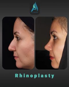 جراحی-طبییعی-بینی-92
