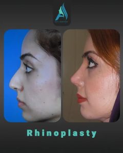 جراحی-طبییعی-بینی-94