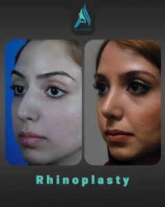 جراحی-طبییعی-بینی-95