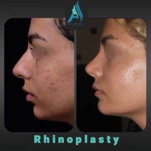 جراحی-طبییعی-بینی-96