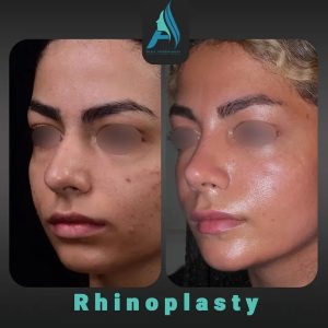 جراحی-طبییعی-بینی-97