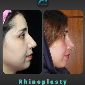 جراحی-طبییعی-بینی-98