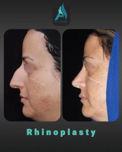 جراحی-طبییعی-بینی-99