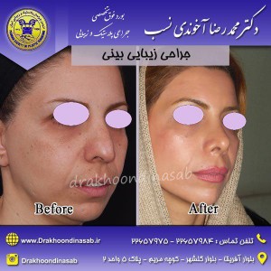 جراحی بینی خانمها 2