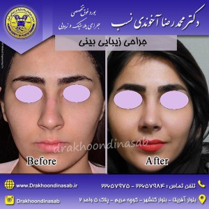 جراحی بینی معمولی (1)