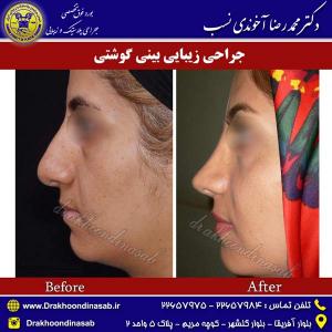 راینوپلاستی-6